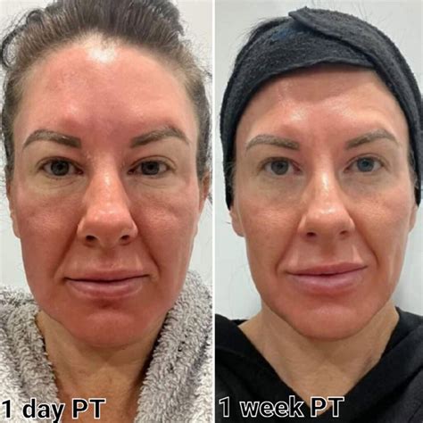 cosmelan rejuvenate laser skin clinic