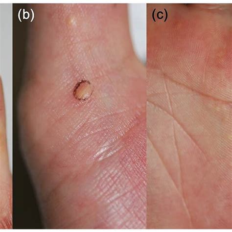 multiple yellowish firm nodules   fingers  palm marked