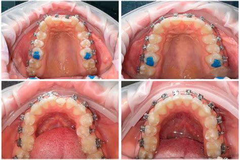 210+ Braces Before And After Stock Photos, Pictures & Royalty-Free ...
