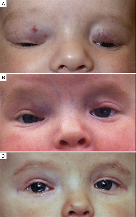 capillary hemangioma eyelid