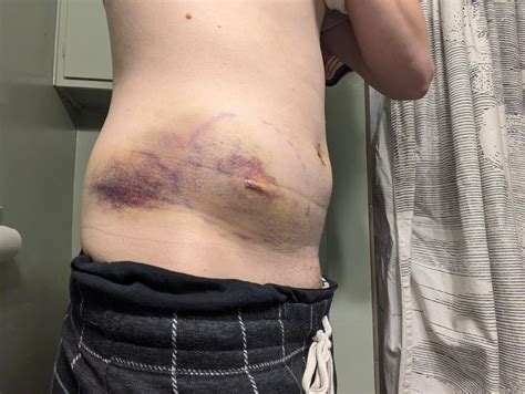 Hematoma After Surgery Should Anything Be Done For A Large Hematoma