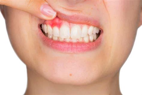 How To Treat Burned Gums From Teeth Whitening | Harpreet Singh Manaktala