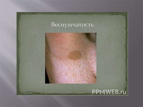 Нейрофиброматоз - презентация онлайн