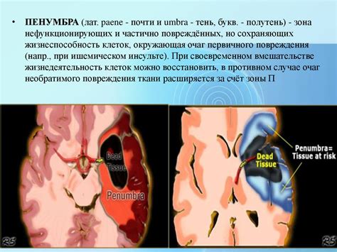 Ишемический инсульт. Этиология. Патогенетические подтипы. Клиника ...