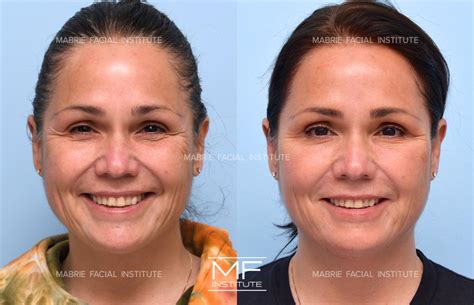 Under Eye Bulging Before and After Pictures Case 916 | San Francisco