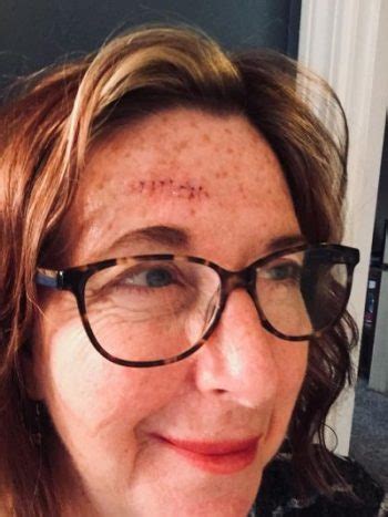 Harry Potter Scar Photos
