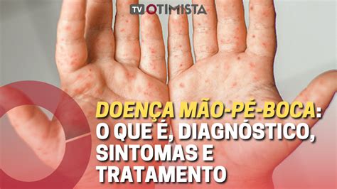 Doença Mao Pe E Boca Pega Em Adulto - Doença mão-pé-boca: o que é, diagnóstico, sintomas e tratamento - TV ...
