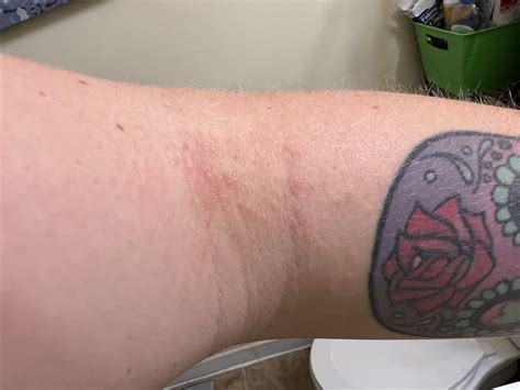 This rash popped up on the inside of my elbow yesterday. Any idea what