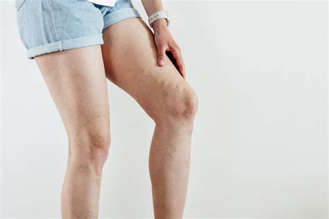 Help! My Varicose Veins Won’t Stop Itching! - IVLC