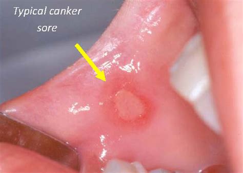 Canker Sores - Treatment