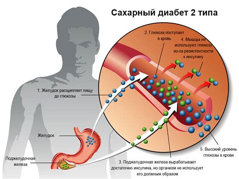 ИНСУЛИН ИЗОФАН - инструкция по применению, аналоги и цена