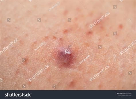 how to treat an infected hair follicle