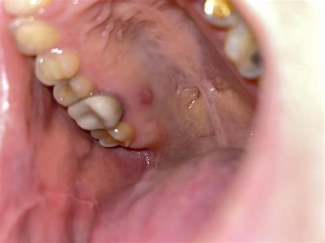 Pimple/lump on roof of mouth. Could it be oral cancer? : r/askdentists