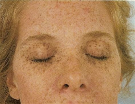 skin health assessment flashcards quizlet