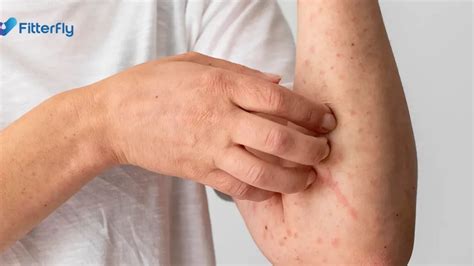 Diabetes Skin Rash Type 2 Diabetes And Skin: Pictures, Dermopathy,