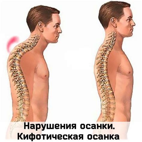 Нарушения осанки. Кифотическая осанка