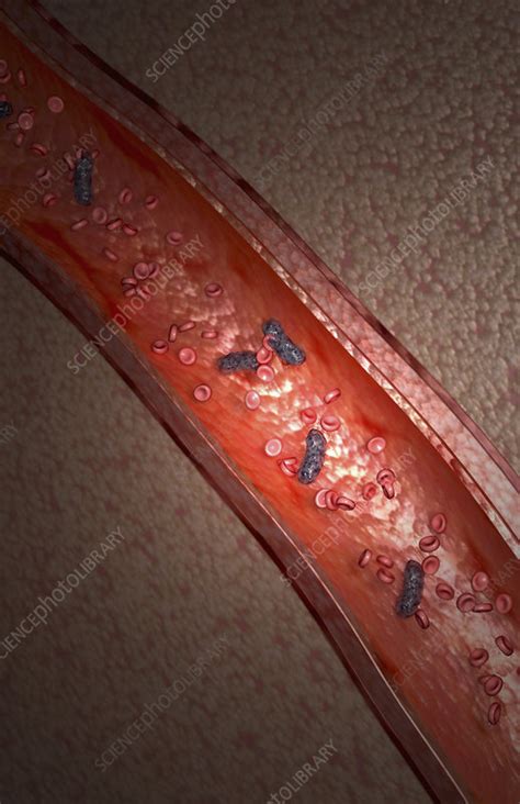 Bacterial blood infection - Stock Image - F002/3125 - Science Photo Library