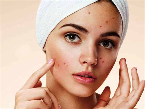 Причины высыпаний на лице | Лицо, Косметика mary kay, Угри