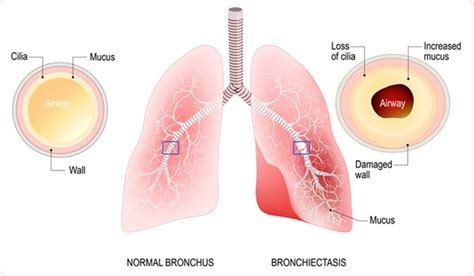 Bronchiectasis Symptoms and Diagnosis