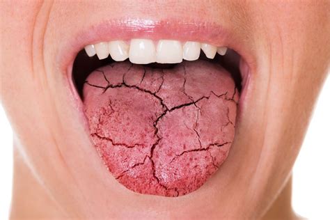 dry mouth  symptoms  solutions bluem uk
