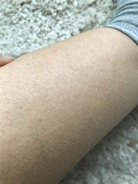 Why is the skin on my legs always scaly and dry? [Skin Concern