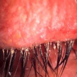 Blefarita cronica | Clinica Novaoptic