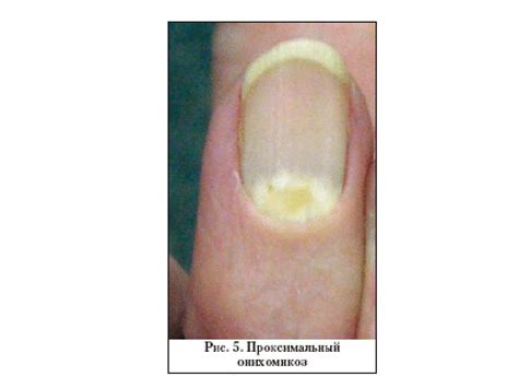 ОНИХОМИКОЗЫ