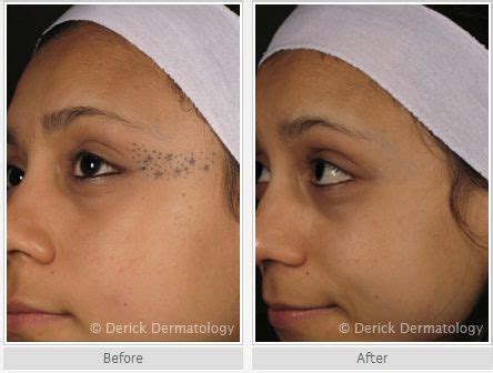 Share 69+ tattoo removal before and after face latest - in.cdgdbentre