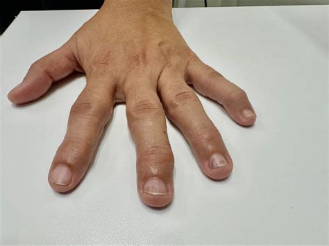 Osteoarthritis of the hands - Doctors Hospital Cayman