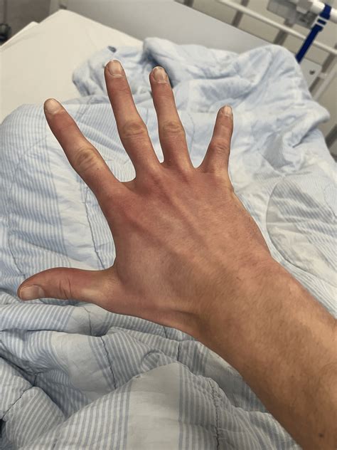 acrocyanosis racrocyanosis