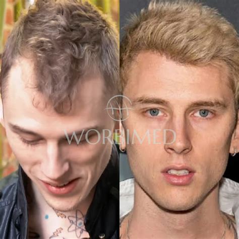 (MGK) Machine Gun Kelly Hair Transplant