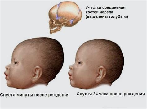 Кефалогематома у новорожденных: лечение и последствия