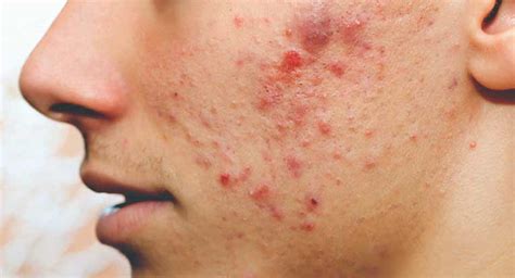 acnepimple treatment  dermatologist  pune skin specialist