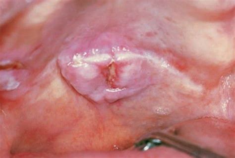 Mucoepidermoid carcinoma - MEDizzy