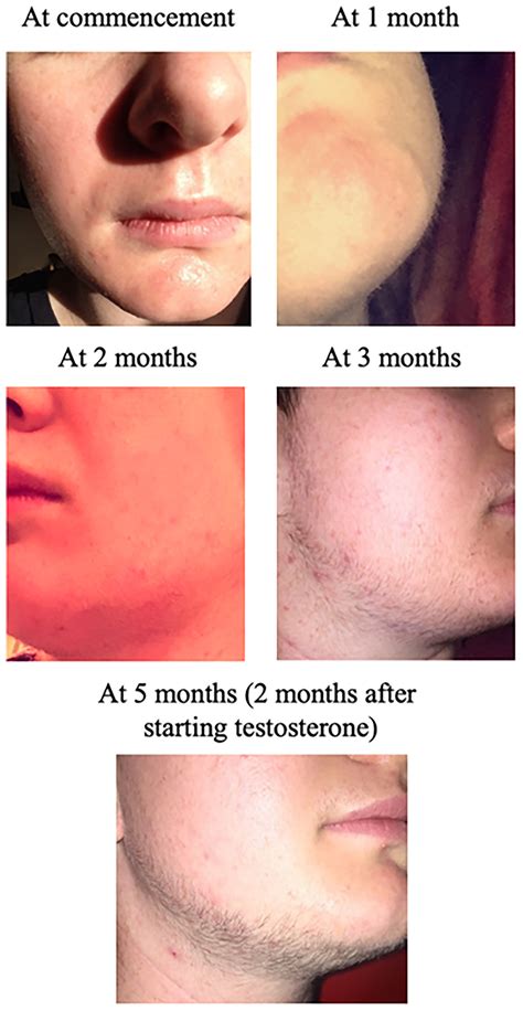 minoxidil women before and after 6