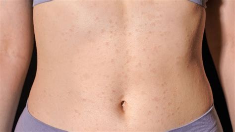 COVID-19 Rash: Types, Symptoms, and Treatment - GoodRx