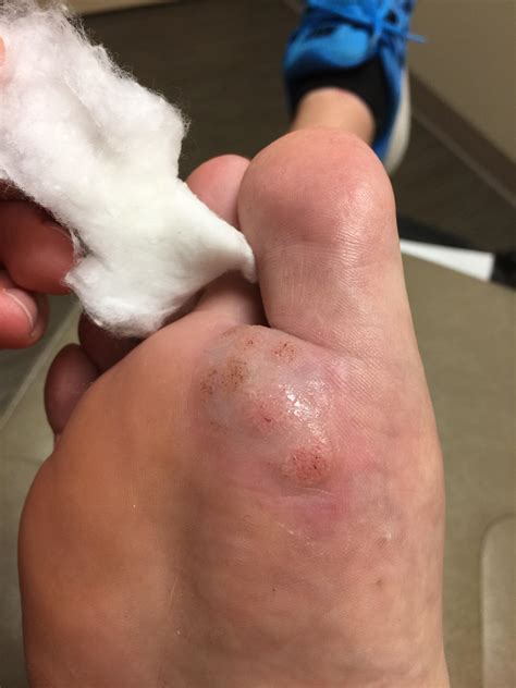 216 best Plantar Wart images on Pholder | Warts, Peeling and Dermatology