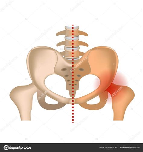 Aseptic Necrosis Hip Bone Damaged Femoral Head Infographic Axis