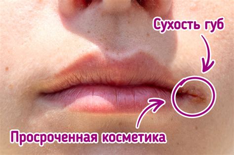 Почему трескаются уголки губ / Бери и делай