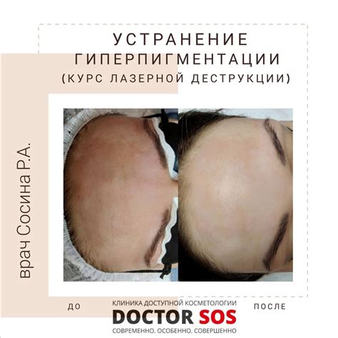 Удаление пигментных и винных пятен | Клиника Инновационной Косметологии ...