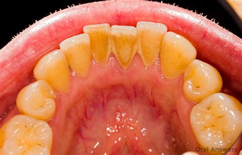 why is tartar bad for your teeth