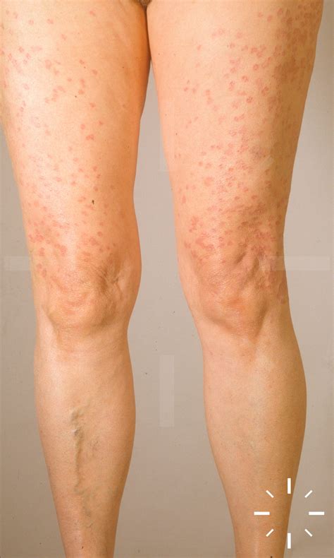 DermaCompass - Granuloma anulare