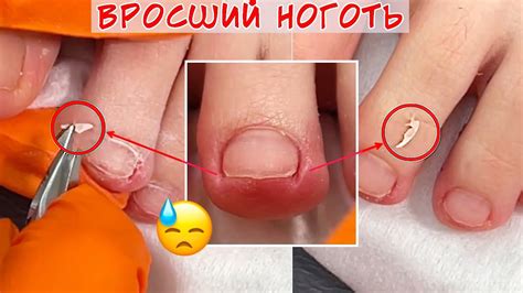 Вросший ноготь на маленьком пальце ноги 🦶 Что делать? - YouTube