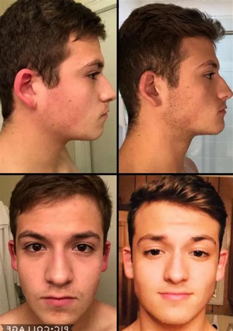 Mewing Before & After: 122+ Progress Photos (Male & Female Transformations)