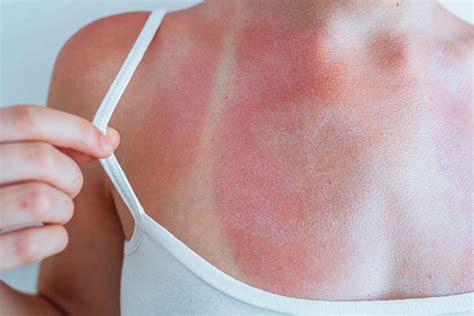 treat sunburns reviva labs
