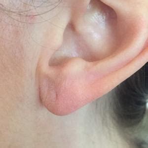 All about earlobes!: West End Facial Plastic Surgery: Facial Plastic Surgery