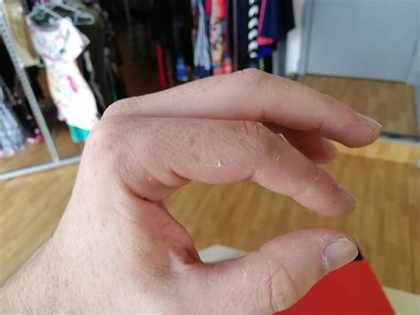 While I'm still waiting for my fingernail to fall off, I thought you