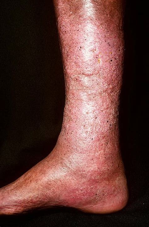 Варикозная экзема фото – 174 шт. / fotodiagnoz.com