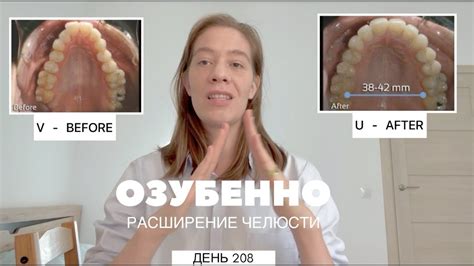 БЕЗ БРЕКЕТОВ день 208: разница между ALF, Planas и брекетами - YouTube