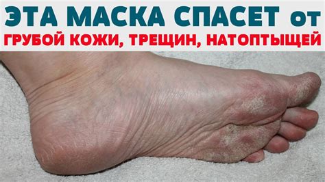 ЛЕГКИЙ СПОСОБ СДЕЛАТЬ ПЯТКИ ГЛАДКИМИ Стопы (ПЯТКИ) без НАТОПТЫШЕЙ ...